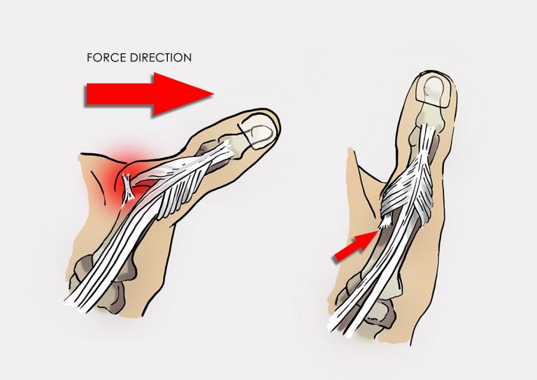 COMMON HAND AND WRIST INJURIES IN STRIKING SPORTS PART 6 Thumb